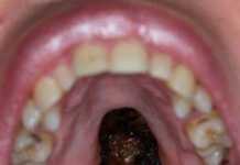 Damaged palate